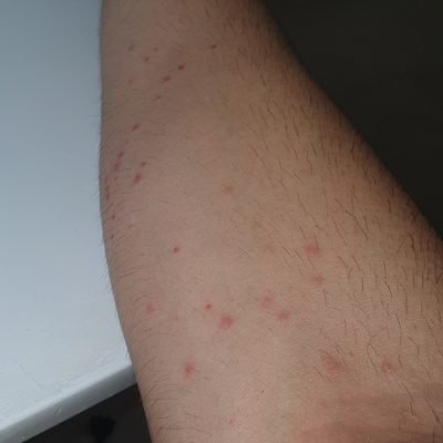 bed-bug-bites-on-forearm